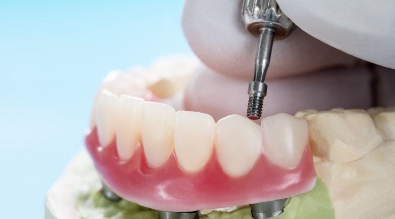 🦷 Parceria com a Med Odonto oferece implante dentário com valores especiais para associados